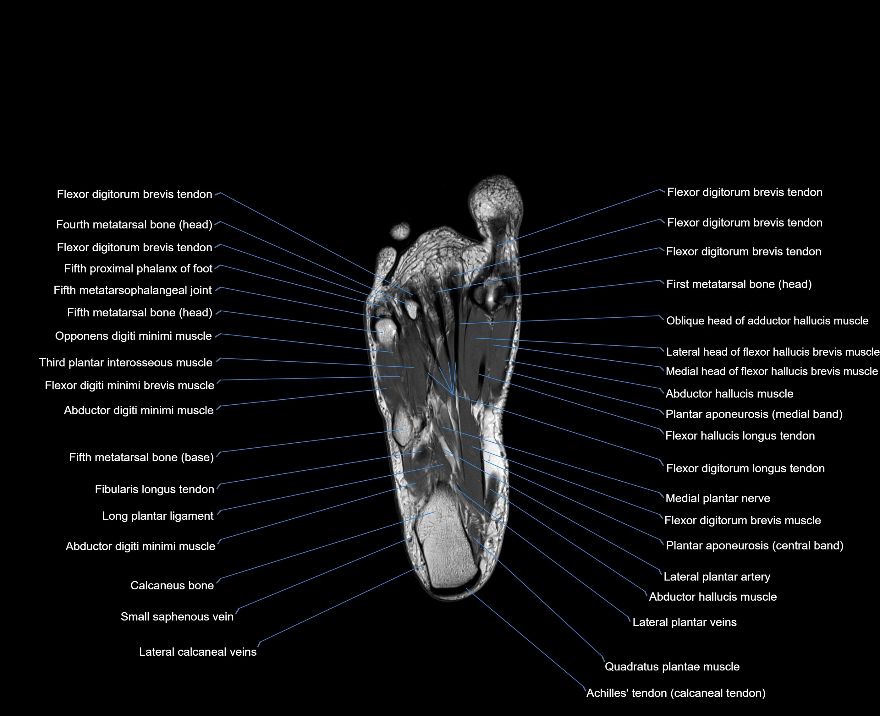 MRI foot coronal cross sectional anatomy 3T  radiology  image-img-00001-00026.webp